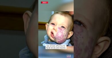 Little Girl Got Surgery to Remove Facial Tumor #shorts