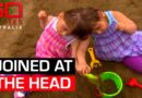 The conjoined twins who see, smell and think the same things | 60 Minutes Australia