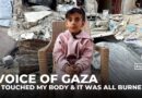 Gaza girl orphaned in Israeli strike rebuilds her life with severe burns