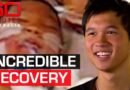 Incredible recovery after world-first limb reattachment surgery | 60 Minutes Australia
