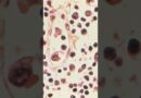 How Dangerous Is Hantavirus?