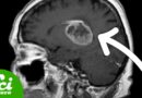 How to Turn Cancer Into Brain Cells