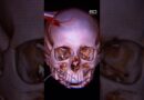 18-year-old survives with a steel pole through his head | 60 Minutes Australia