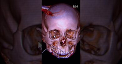 18-year-old survives with a steel pole through his head | 60 Minutes Australia